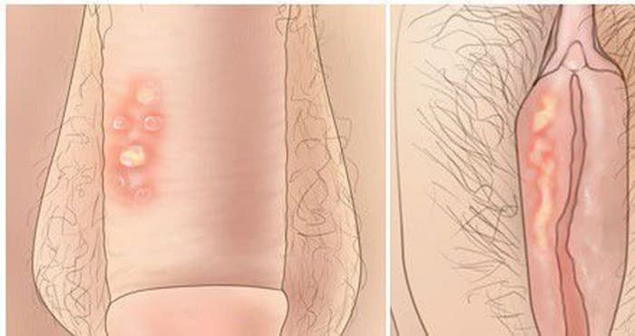 Jual Obat Sipilis De Nature Pengiriman ke Surabaya