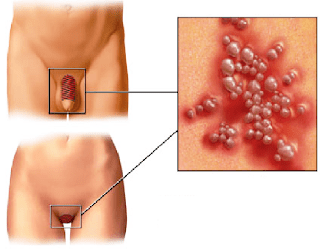 Jual Obat Sipilis De Nature Pengiriman ke Rejang Lebong